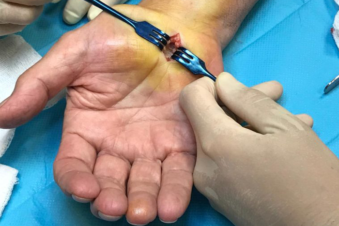 compresiones nerviosas unidad de mano clinica duque compresiones nerviosas unidad de mano clinica duque