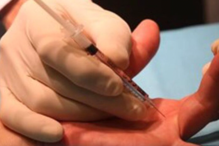tratamiento enfermedad de depuytren en clinica duque tratamiento enfermedad de depuytren en clinica duque