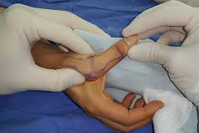 lesiones-ligamentosas dedo_en_resorte
