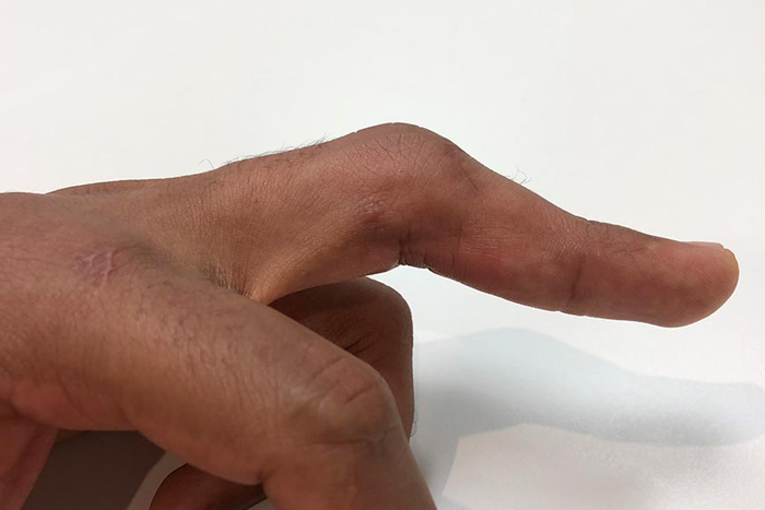 lesiones-tendinosas dedo_en_resorte