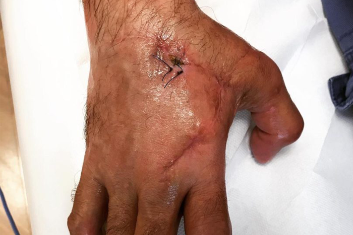 recuperacion-grandes-lesiones-en-mano-clinica-de-fisioterapia-duque compresiones_nerviosas